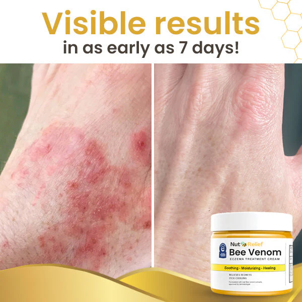 NutRelief™ Bee Venom Eczema Treatment Cream